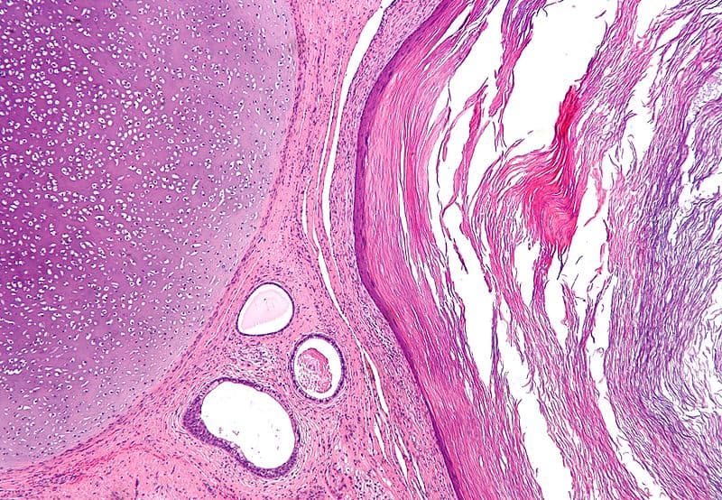 Tumor met tanden ontdekt in Romeins skelet | Archeologie Online