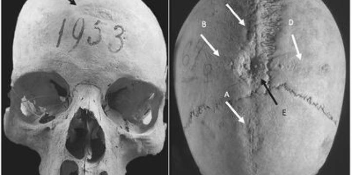 De gevonden schedel met chirurgische ingrepen