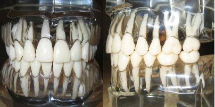 Laster Danser tempel Oudste tandprothese in West-Europa gevonden | Archeologie Online
