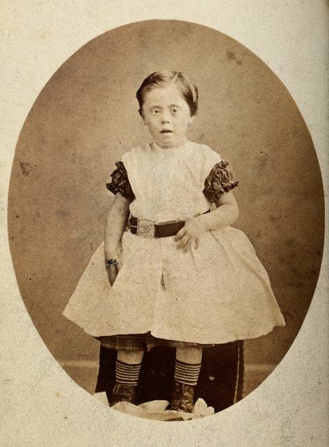 Een jong meisje met het syndroom van Down, negentiende eeuw.