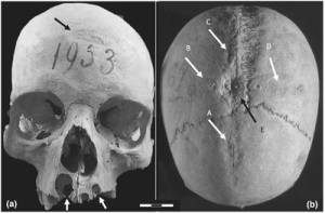 De gevonden schedel met chirurgische ingrepen